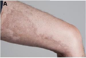 Figure 1. The spectrum of cutaneous findings in ScGVHD.