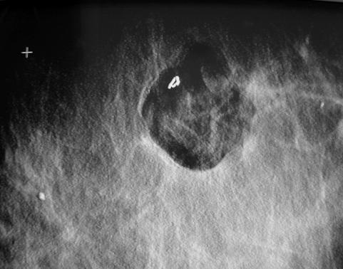 Quadro III Resultados Histológicos (Peça Operatória) Nº de Casos % Carcinoma Ductal in Situ 13 37 Carcinoma Ductal Invasivo 15 3 Carcinoma Ductal Microinvasivo 11 Carcinoma Lobular Invasivo 1 3 Sem