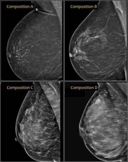 COMPOSIÇÃO a) lipomatosa b) fibrolipomatosa c) fibroglandular