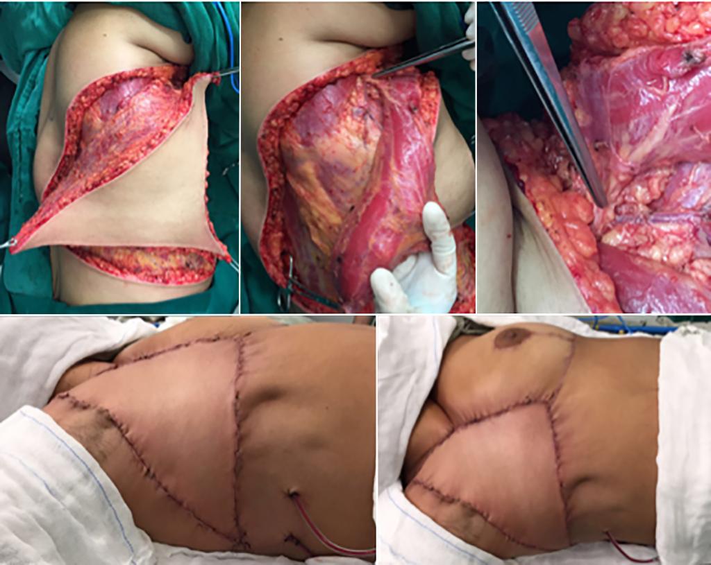 Silva MMA et al. Figura 7. Intraoperatório de paciente portadora de sarcoma de partes moles do tórax recidivado.