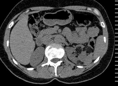 Introdução 1.3.1. Radiologia A radiografia de tórax pode apresentar-se normal ou mostrar sinais de pneumotórax ou derrame pleural.