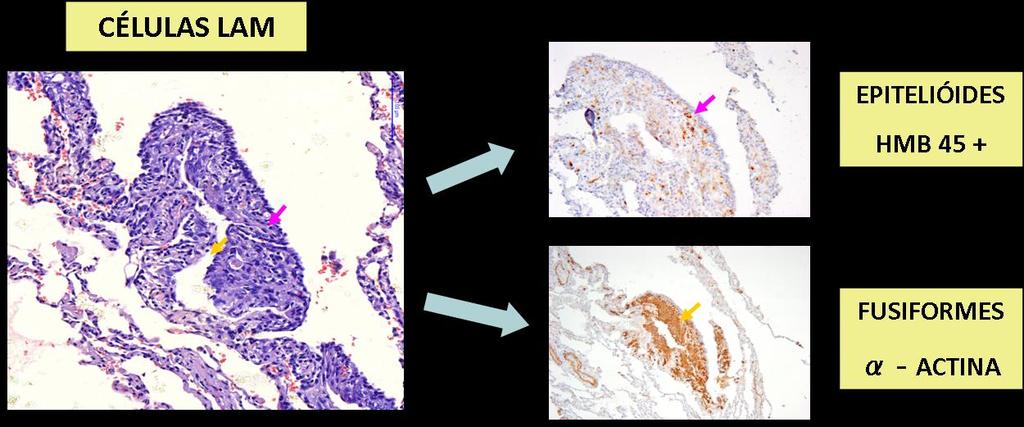 Introdução Figura 3. Células LAM: morfologia e marcadores imunohistoquímicos, obtidas de material de biópsia de paciente do estudo. Aglomerado de células LAM, localizado na parede do cisto pulmonar.
