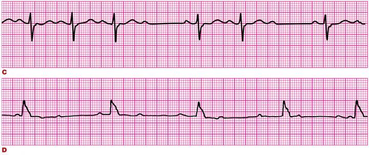 Avaliação de Ritmo: Bradicardia < 60bpm; Sintomas em geral < 50bpm Não conduziu BAV de 2º Grau MOBITZ