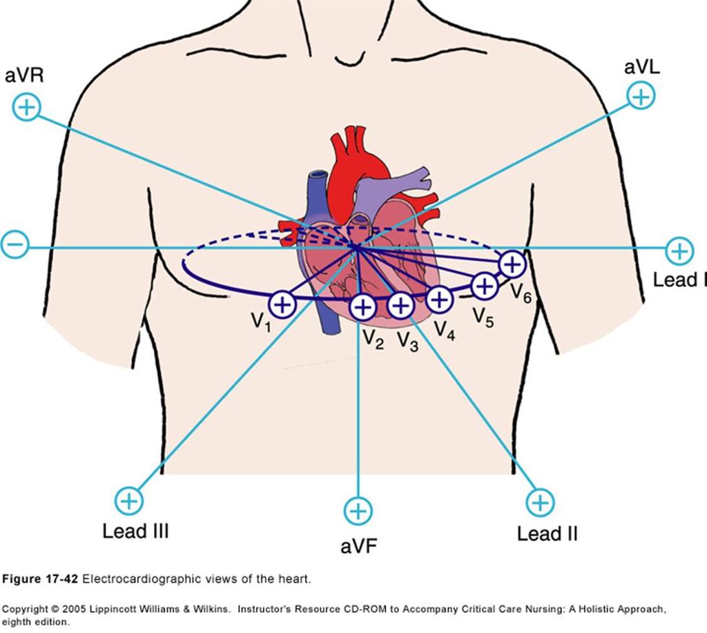 Derivações IAM com Supra de ST Axiais: DI, DII e DIII avr, avf e avl Precordiais: V1, V2.