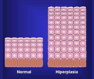 Hiperplasia é um aumento do número de células de determinado tecido, e é um processo proliferativo comum durante período de crescimento rápido do corpo (p.