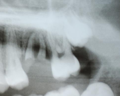 INTRODUÇÃO A reabilitação de espaços edêntulos representa um grande desafio à odontologia, especialmente em perdas dentárias precoces, pelos aspectos estéticos e funcionais associados.