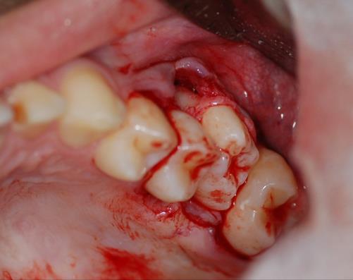 Em seguida, realizou-se um retalho triangular para exodontia do dente 28 associado a um descolamento mucoperiosteal para exposição ampla deste terceiro molar e menor traumatismo possível durante a