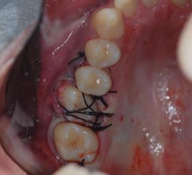 Além disso, foi feita a curetagem do tecido de granulação formado no alvéolo do dente 26, bem como a remoção parcial do septo interdental com alveolótomo para a eliminação de interferências e melhor