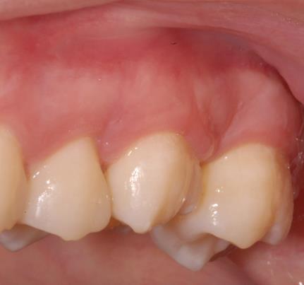 Além disso, certificou-se de que o elemento transplantado estava em desoclusão total em todos os movimentos mandibulares, não havendo, portanto, a necessidade de ajuste oclusal (Figuras 3 e 4).