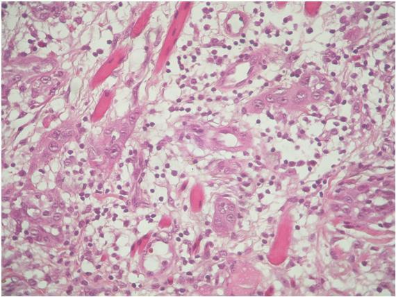 Carcinoma de células escamosas indiferenciado em paciente jovem: relato de caso FIGURA 3: Pequenas ilhotas de células epiteliais malignas próximas a vasos sanguíneos (HE, 400x).