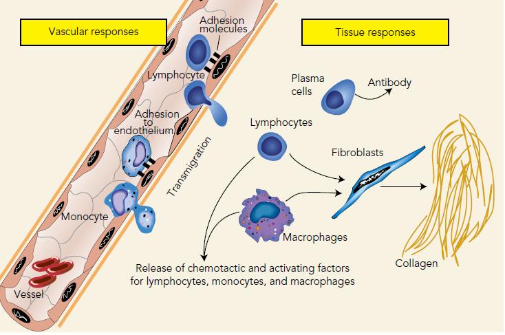 Resposta Inflamatória - Crônica Resposta Vascular Resposta Tecidual Células plasma Anticorpo Fibroblasto Tr an s mi gr aç ão Linfócito