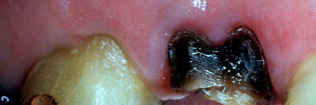 O tratamento do dente 16 iniciou-se com a remoção do tecido cariado e preparo da estrutura