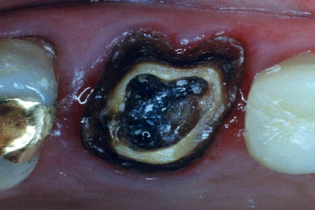 Porém, a estrutura dentaria remanescente foi considerada suficiente para alojar um núcleo de
