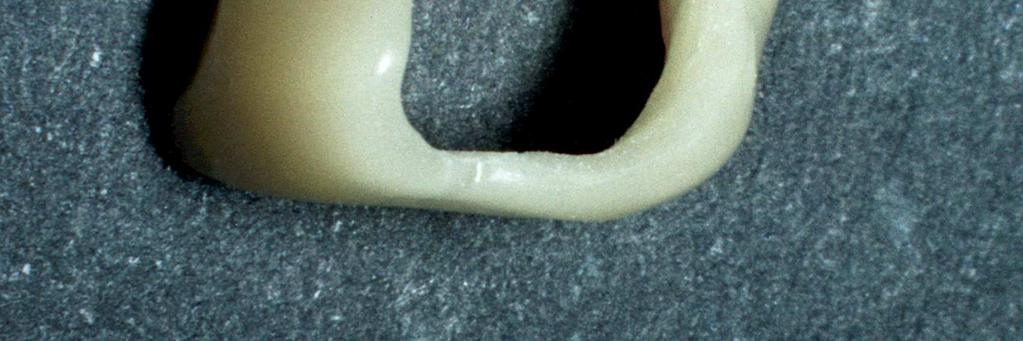 Figura 2a e b - Coroa provisória em resina acrílica posicionada sobre o preparo (Vistas lateral