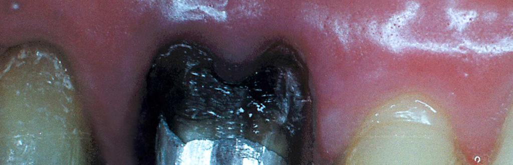 toda a região marginal, o que em áreas de difícil acesso dificulta sobremaneira a finalização do preparo no dente em questão (Fig. 9).