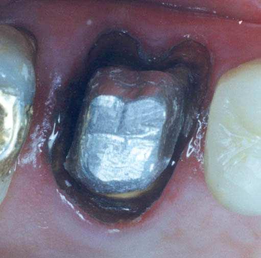 È importante que, antes de se confeccionar a coroa provisória, a margem do dente em tratamento esteja preferencialmente supragengival e que seu formato já esteja definido.