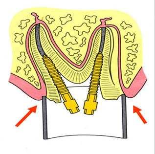 Fig. 9 Diagrama ilustrando o posicionamento da matriz convencional ao redor da estrutura dentaria. Observe que desta forma, o amalgama, após sua condensação, ocupará toda a superfície marginal.