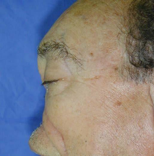 DISCUSSÃO Uma reconstrução nasal anatômica baseia-se em um contraste favorável entre o nariz e os tecidos Rev. Bras. Cir. Plást.