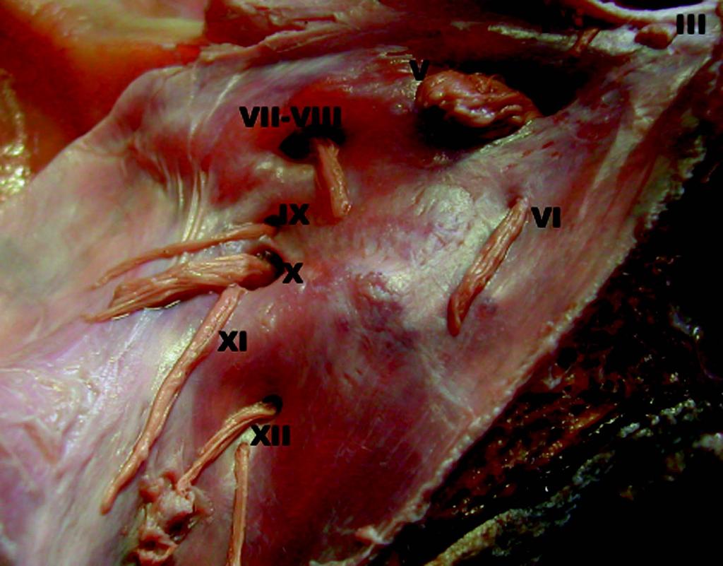 Arq Neuropsiquiatr 2003;61(2-B) 443 Fig 1. Face posterior da pirâmide petrosa esquerda com os nervos cranianos. Fig 3.