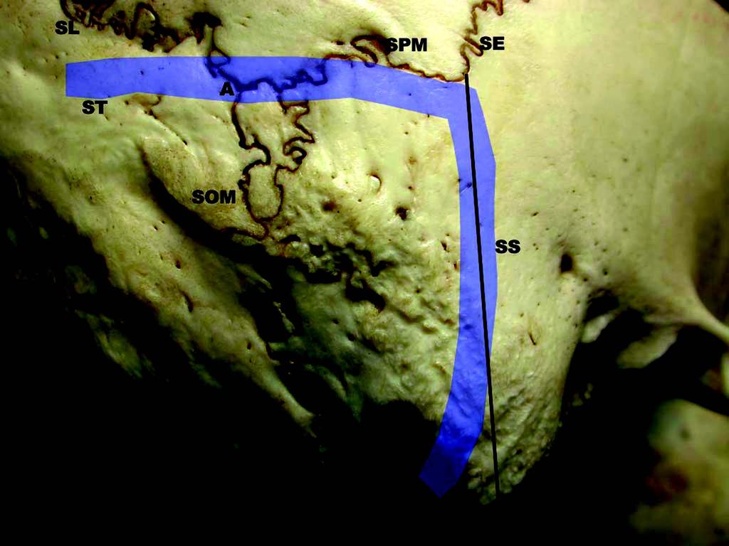 Representação dos seios durais e dos nervos cranianos que se relacionam com a face posterior da pirâmide petrosa esquerda. SPS, seio petroso superior; SPI, seio petroso inferior; SS, seio sigmóide.