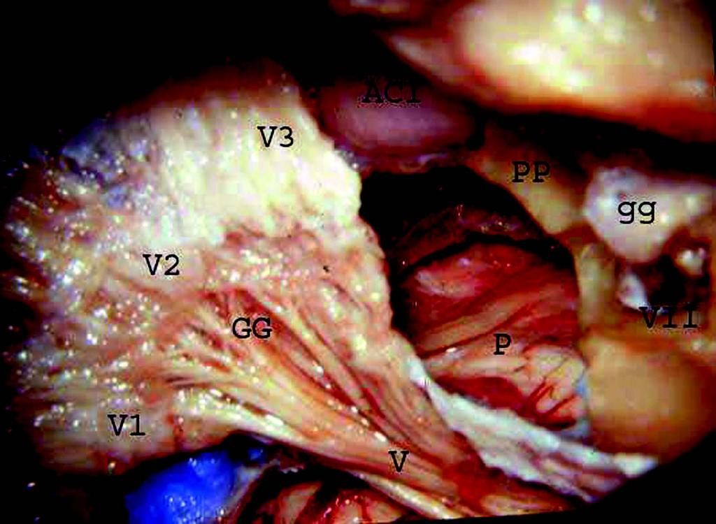 ramo maxilar; V3, ramo mandibular; P, ponte; VII, nervo facial; gg, gânglio geniculado; ACI, porção horizontal da artéria carótida interna; PP, resquício do ápice da pirâmide petrosa (supratentorial).