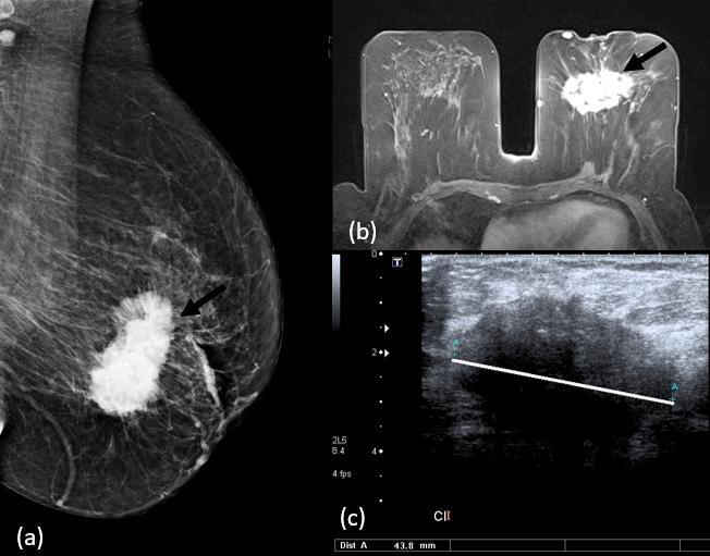 câncer de mama fica completamente hipoecóico na imagem (Figura 1c).
