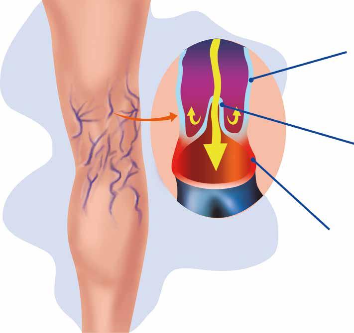 O QUE É INSUFICIÊNCIA VENOSA CRÔNICA? As veias possuem válvulas que ajudam a empurrar o sangue das pernas no sentido do coração.