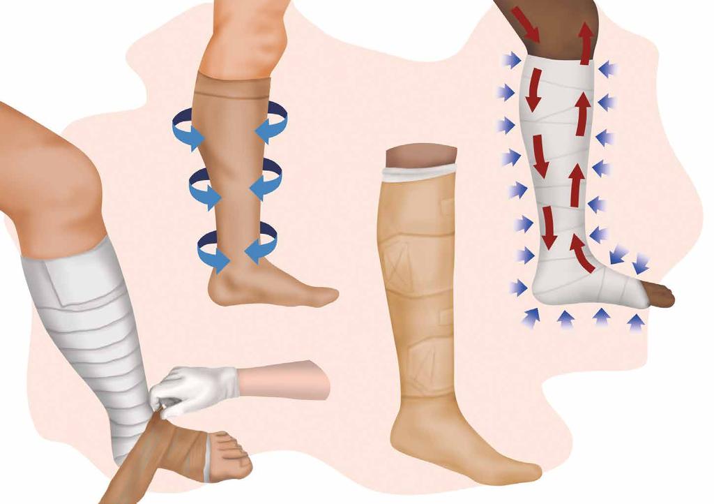UTILIZANDO TERAPIA COMPRESSIVA O edema ou inchaço na perna resulta do acúmulo de líquido entre os