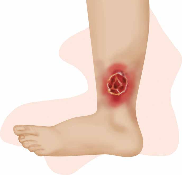 A prevenção e tratamento da ferida deve ser feita por meio de terapia compressiva da perna, com uso de