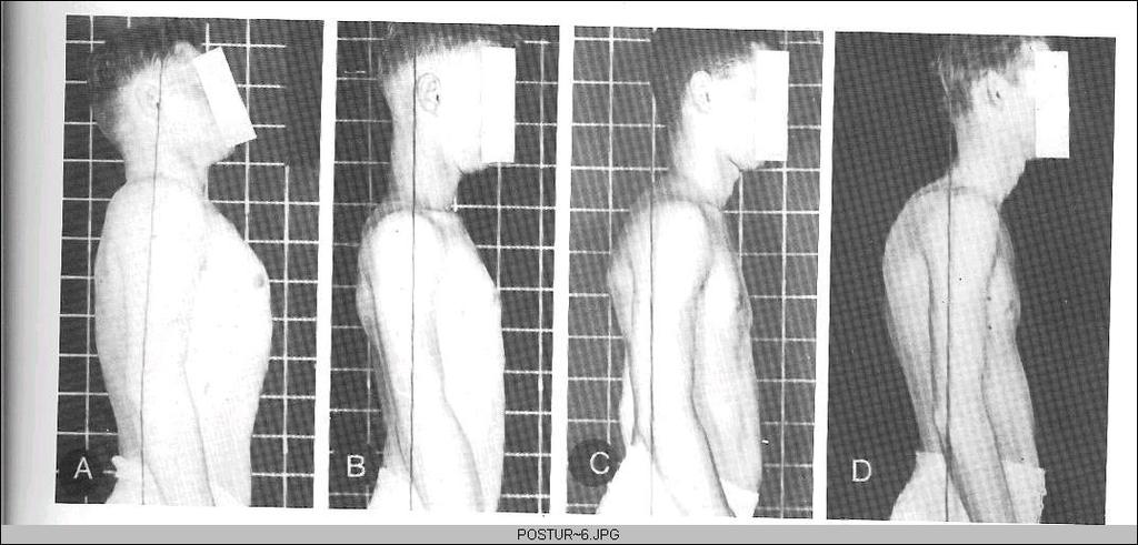 Principais desvios posturais Vista Lateral Coluna Cervical - Cabeça