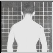 Principais desvios posturais Vista Posterior Ombros e escapulas Ombros deprimidos e escapulas