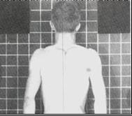Medial) e romboides (hipotônicos) Principais desvios posturais Vista Posterior Ombros e escapulas