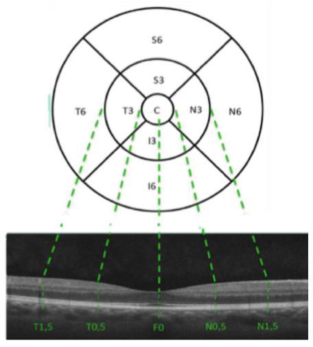 9 A coróide foi identificada como a estrutura delimitada entre a interface externa do epitélio pigmentar da retina e a interface interna identificada como a linha hiperreflectiva atrás dos grandes