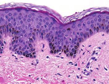 cuboidais; melanosomas mais grossos em pele escura Imuno-histoquímica: Citoqueratina, p63.