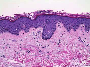 (a) A parte mais alta da pele derivada do ectoderma, ilustrando o estrato córneo em um