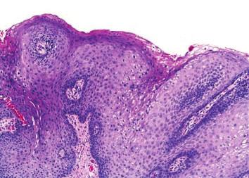 1 Variações da camada granulosa Proeminente Pele acral Ausente Mucosa (*presente na língua)