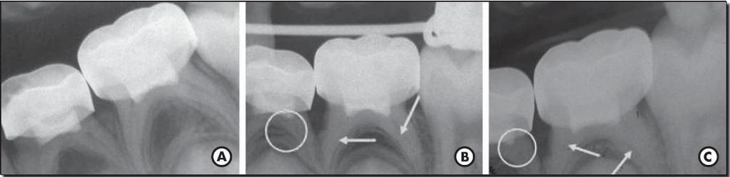 Figura 3: Radiografia dos dentes 74 e 75. A-12 meses após pulpotomia realizada com MTA. B-36 meses após pulpotomia realizada com MTA. C-42 meses após pulpotomia com MTA.