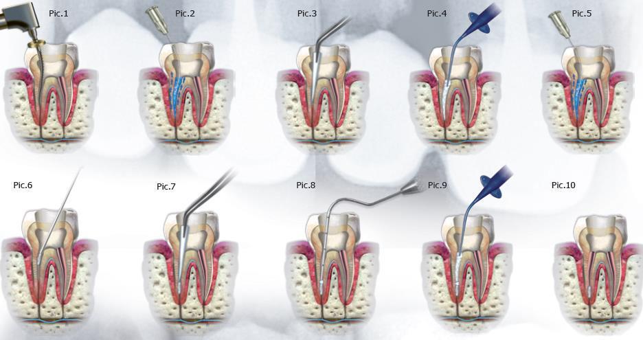 A capacidade indutora de cementogénese do MTA previne a inflamação periapical por eliminação de microorganismos que desencadeiam respostas inflamatórias.