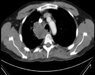 paravertebral direita e