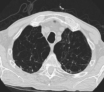 Linha de junção anterior Linha de junção posterior Linha paratraqueal direita Linha paratraqueal esquerda Janela aortopulmonar Linha paravertebral direita e esquerda Recesso azigo-esofágico Margens