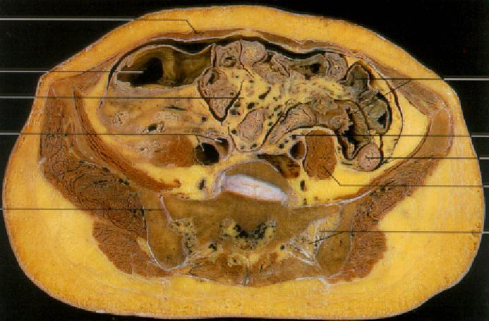 Síndrome Metabólica É um transtorno complexo representado por um conjunto de fatores de risco cardiovascular usualmente