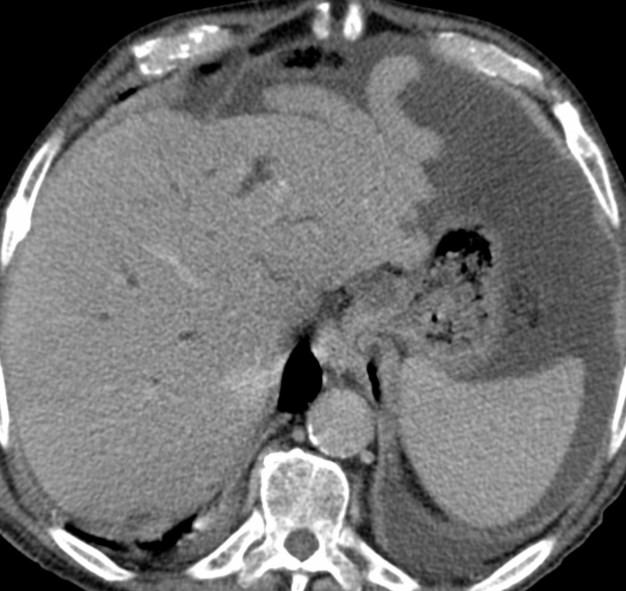 LIGAMENTOS Conectam órgãos parenquimatosos à parede abdominal L. coronário (lc) L. gastrohepatico L. hepatoduodenal (lhd) L.