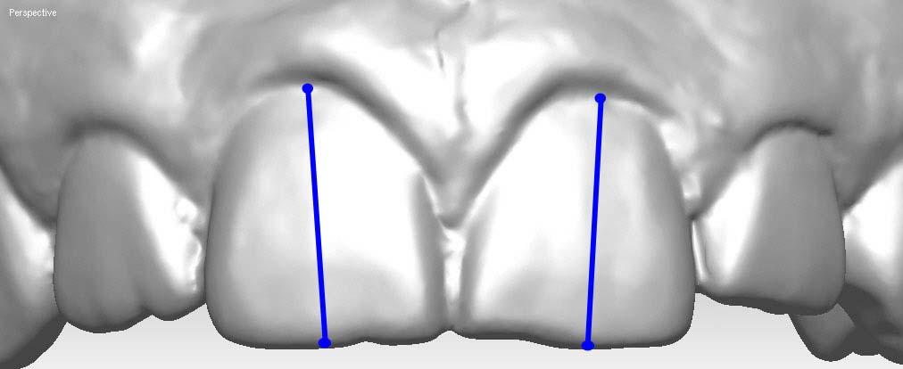 89 89 4.2.7.2 vetores tridimensionais. Eixo vertical da coroa clínica: Vetor obtido da união entre os pontos cervical e borda incisal (Figura 4.17).
