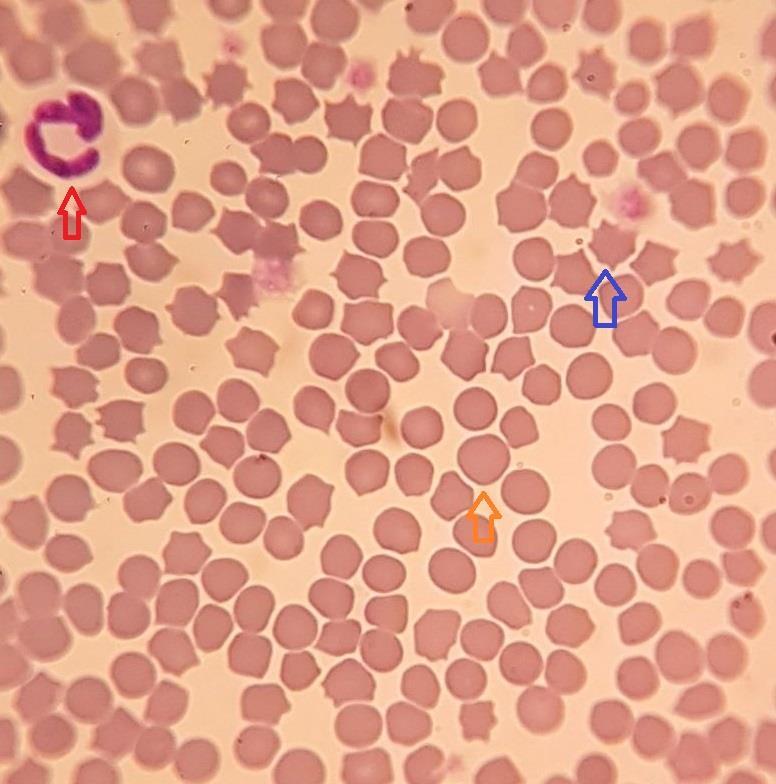 Ao analisar a tabela 1, referente aos resultados dos exames eritrocitários realizados no paciente, constatou-se que o mesmo apresenta um quadro de anemia, em conjunto com hematócrito baixo, VCM