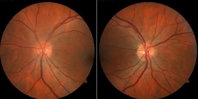 Posner-Schlossman e Dispersão Pigmentar INTRODUÇÃO A elevação unilateral aguda da pressão intraocular (PIO) é comum e costuma aparecer com certa frequência na urgência oftalmológica 1.