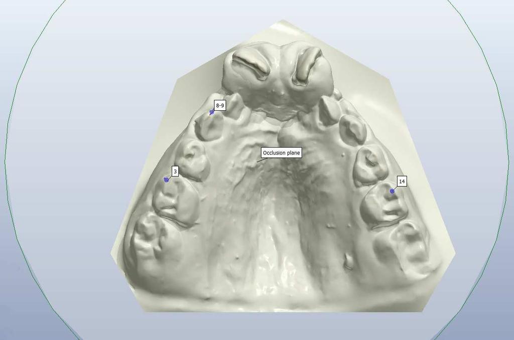 canino e prótese/implante no lugar do segundo pré-molar traçou-se o plano oclusal
