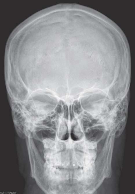 Crânio: Radiografias Veja também Prancha 11 Vista anterior posterior Sutura sagital Sutura coronal Sutura lambdóidea Asa menor do osso esfenoide Parte petrosa do osso