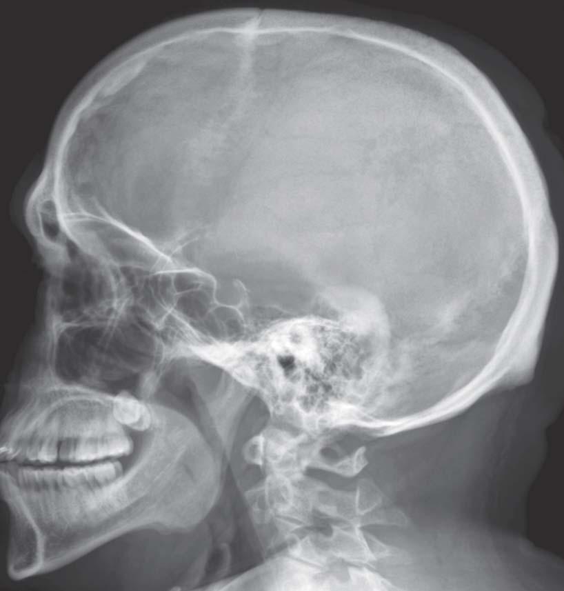 Crânio: Radiografia Lateral Veja também Prancha 15 Osso parietal Orelha Sutura lambdóidea Sutura coronal Osso frontal Seio frontal Asa maior do osso esfenoide Processo clinoide anterior Sela turca