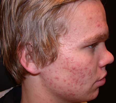 Metvix - acne: development of a new indication Proof-of-concept study completed - presentation at the