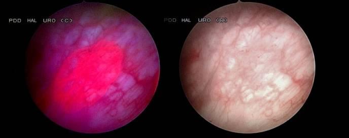 cystoscopy after one